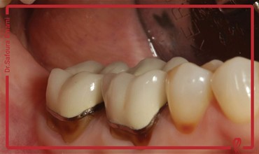 آیا کامپوزیت باعث خرابی و پوسیدگی دندان می شود؟